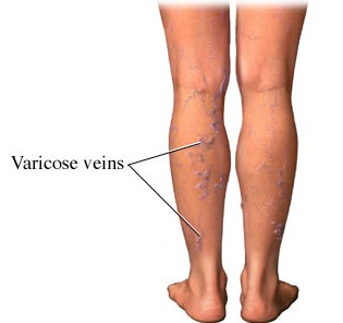 Varicose veins